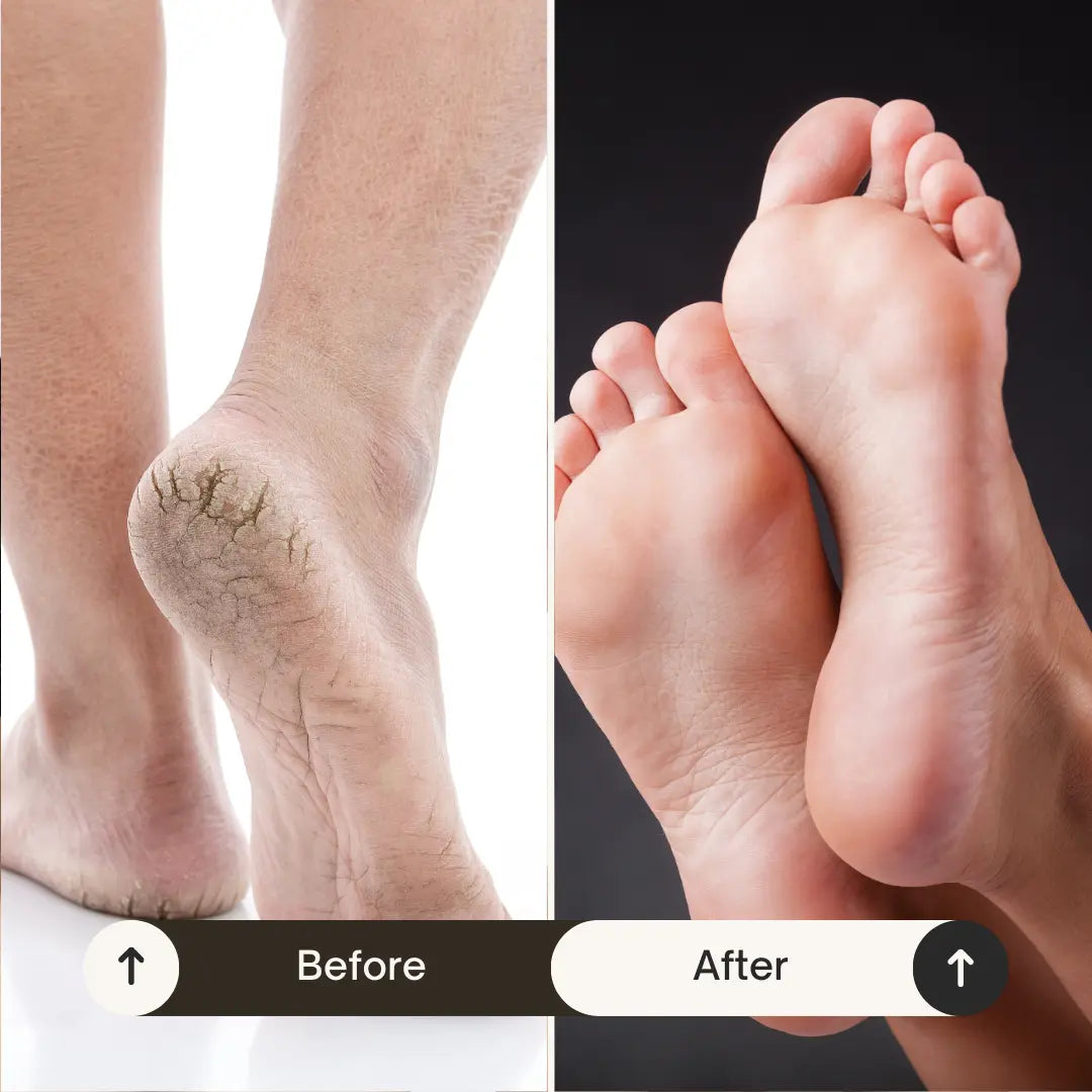 Reqah - 5-Day Heel Healing Solution